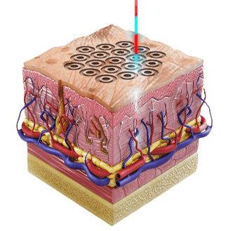 High-Resolution Laser Resurfacing