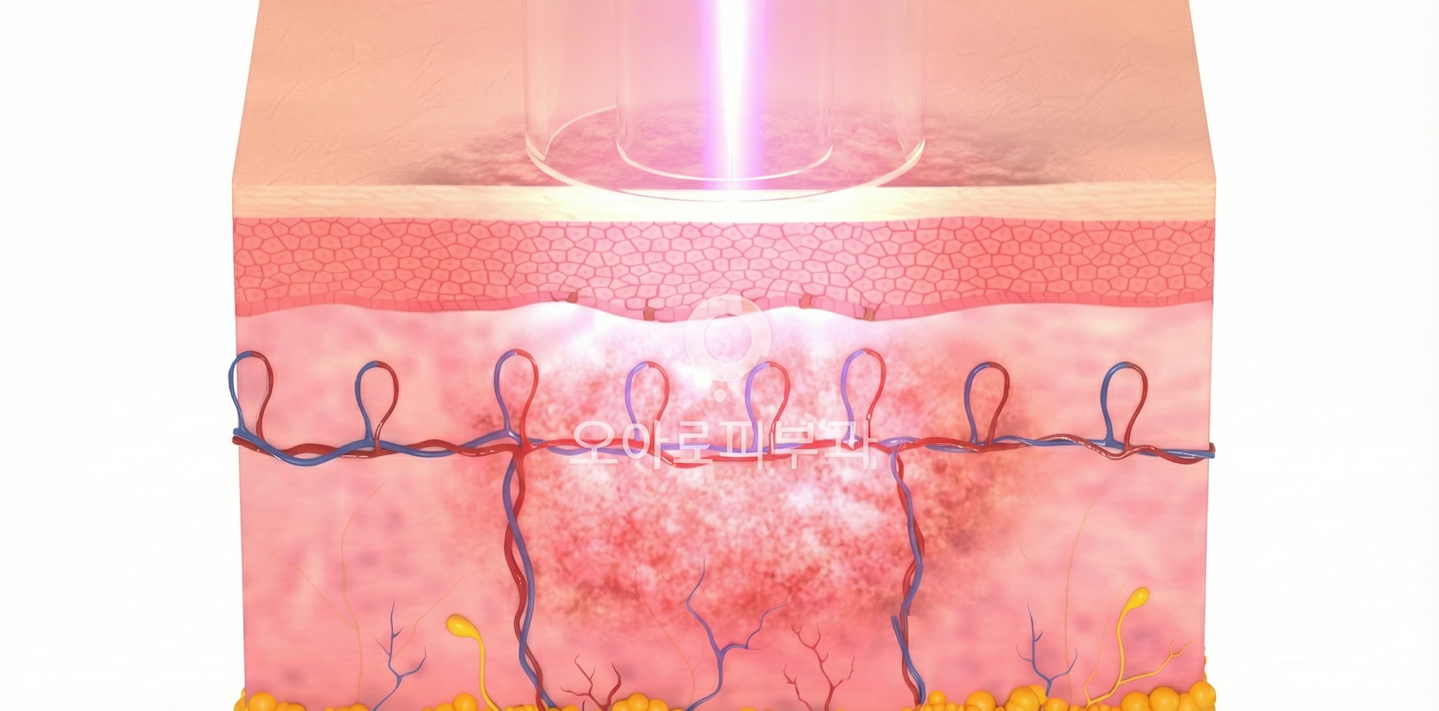 STEP 2. Laser Energy Absorption