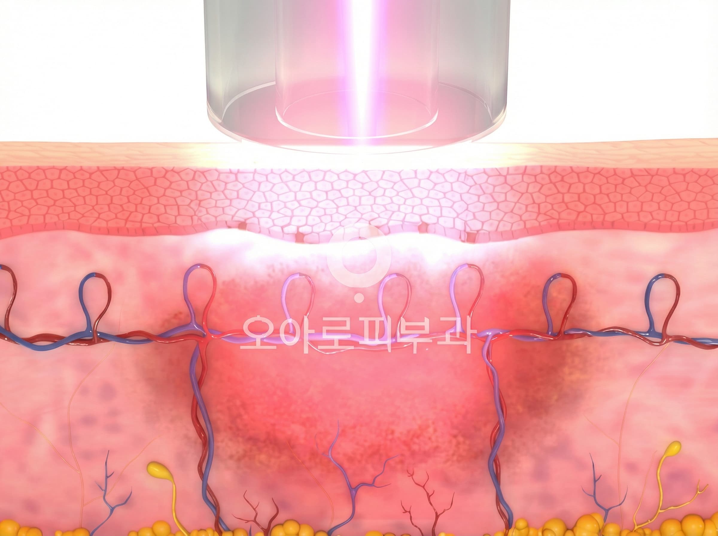 STEP 1. Pigment Lesion Targeting