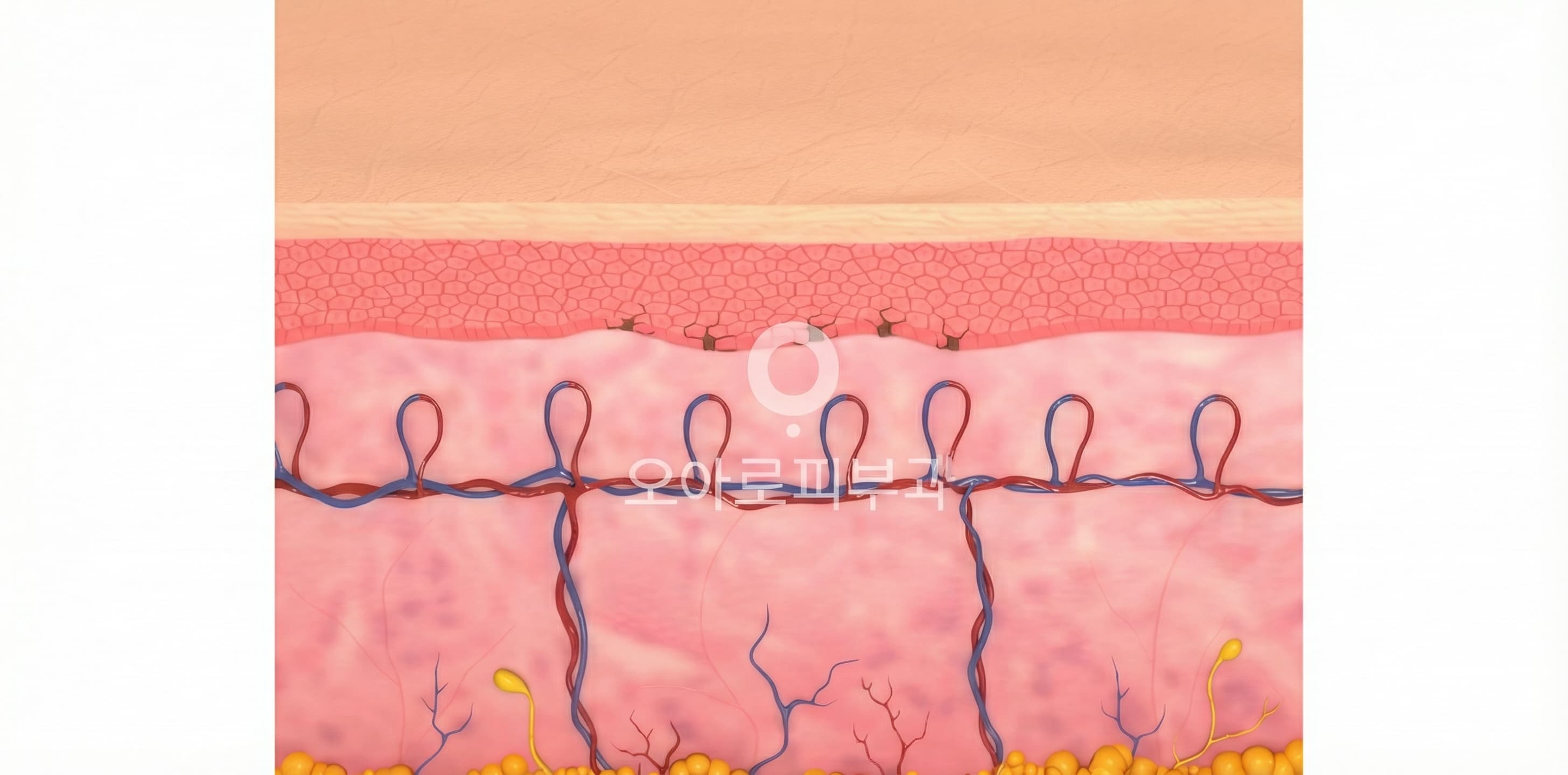 STEP 3. Pigment Destruction & Elimination